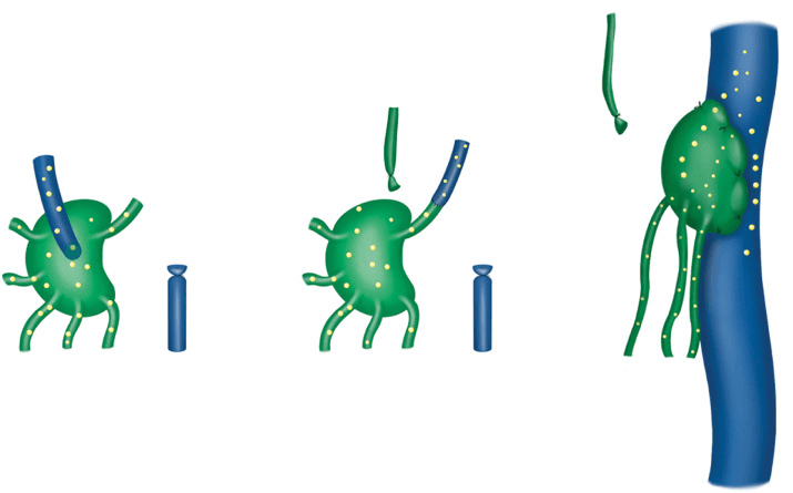 Technique of LVA surgery visualized