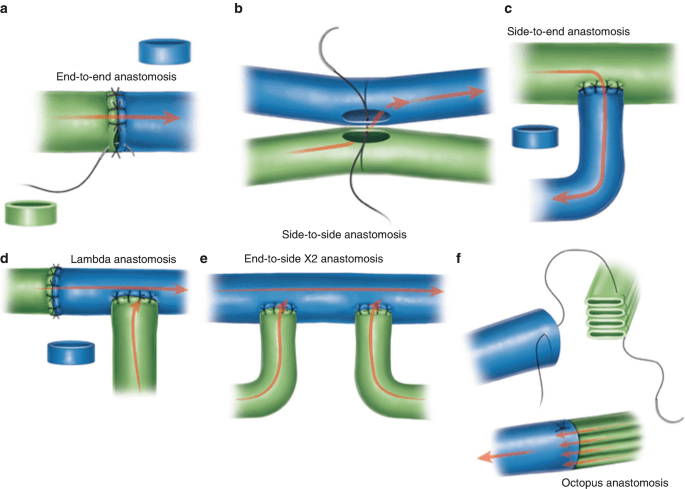 Technique of LVA surgery visualized